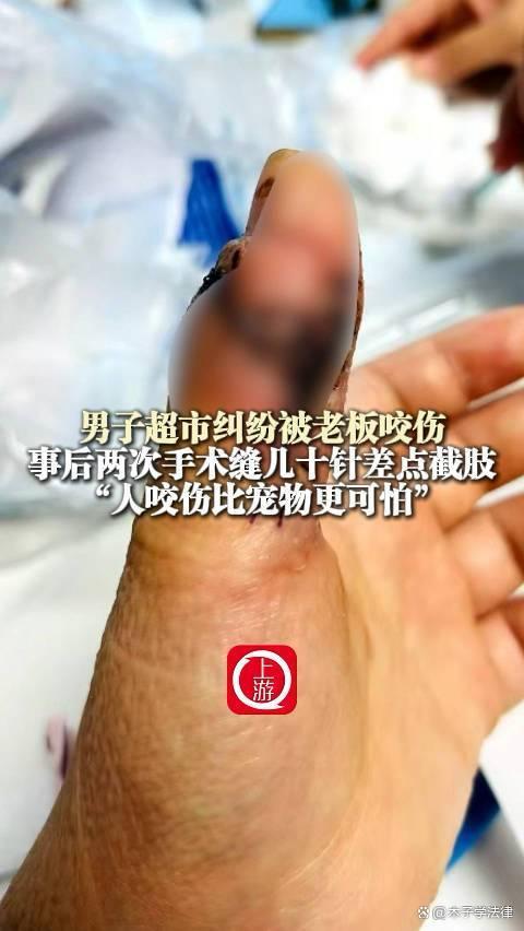 被老板咬伤险截肢事件揭秘，背后的真相与法规解读